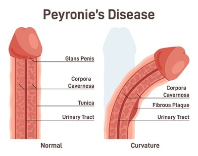 Schematische weergave van een normale penis en een penis met de ziekte van Peyronie